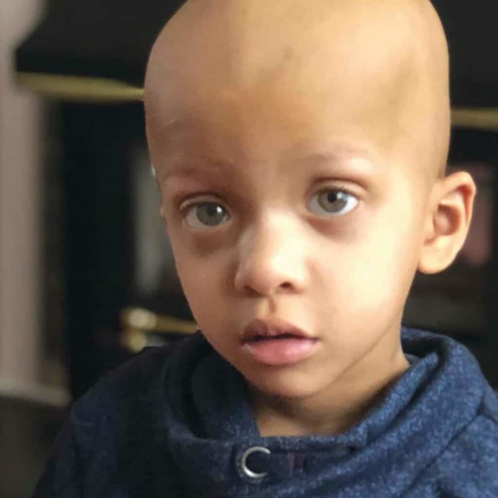 A young boy with bald head looking at the camera